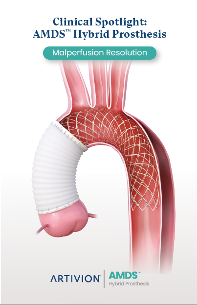 AMDS Clinical Spotlight: Malperfusion Resolution
